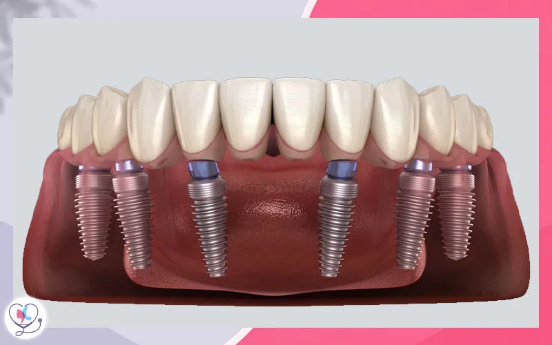 All-on-6 Dental Implants