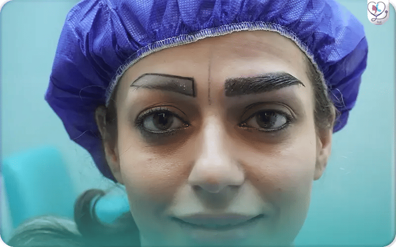 Eyebrow Transplant Cost Breakdown in Turkey