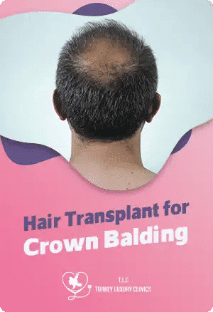 Haartransplantation bei Scheitelglatze: Lösungen und Ergebnisse