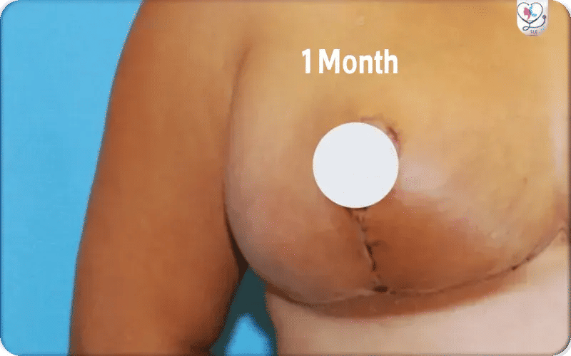 Breast Reduction First Results: 1 Month