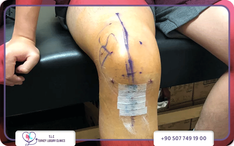 مدة ثني الركبة بعد عملية الرباط الصليبي