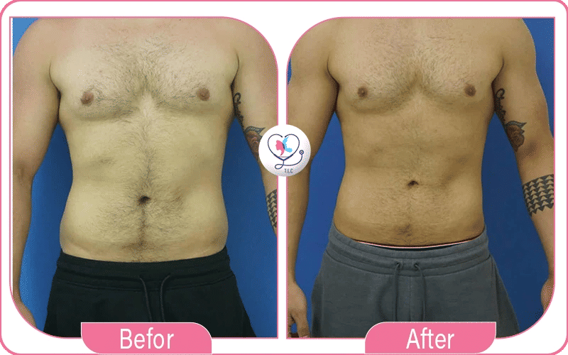 liposculpture avant après-3