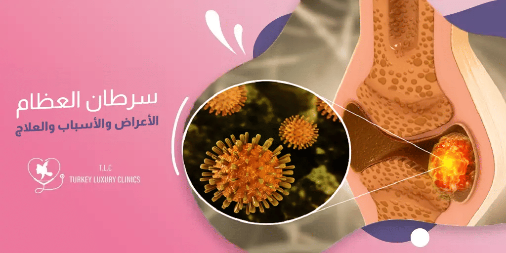 سرطان العظام: الأعراض والأسباب والعلاج