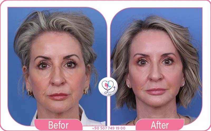 سعر عملية شد الوجه حسب التقنية