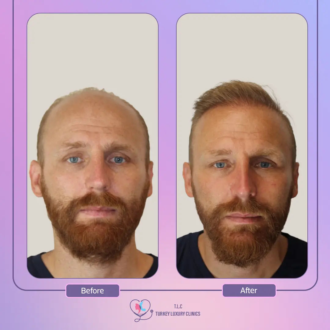 نتائج زراعة الشعر بالصور