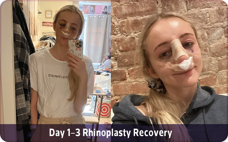 Day 1–3 Rhinoplasty Recovery with Photos
