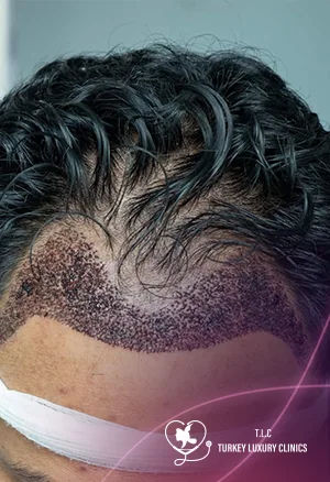 2000 Grafts Hair Transplant Cost Turkey 2026