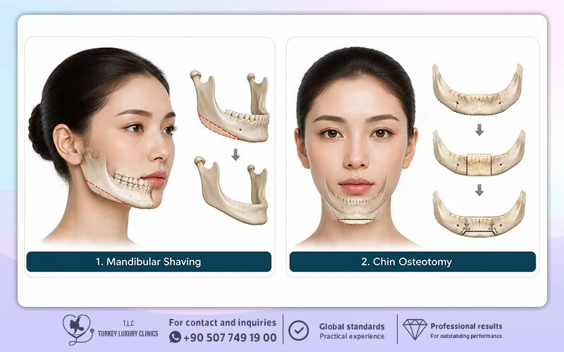 How Is V-Line Jaw Surgery Performed?
