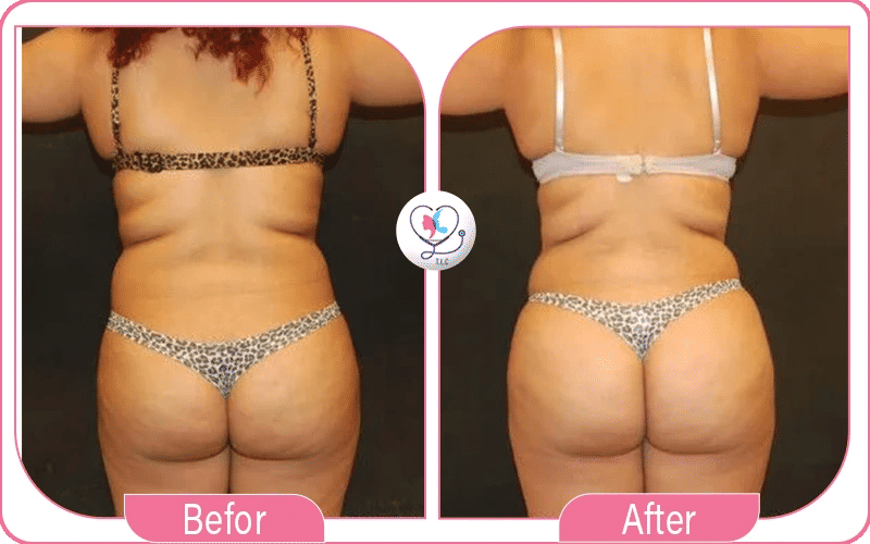 Lipofilling fessier avant / après-5