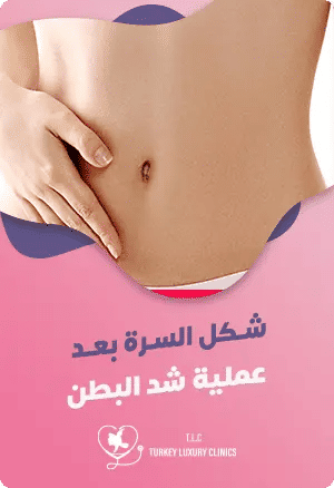 شكل السرة بعد عملية شد البطنfeatured image