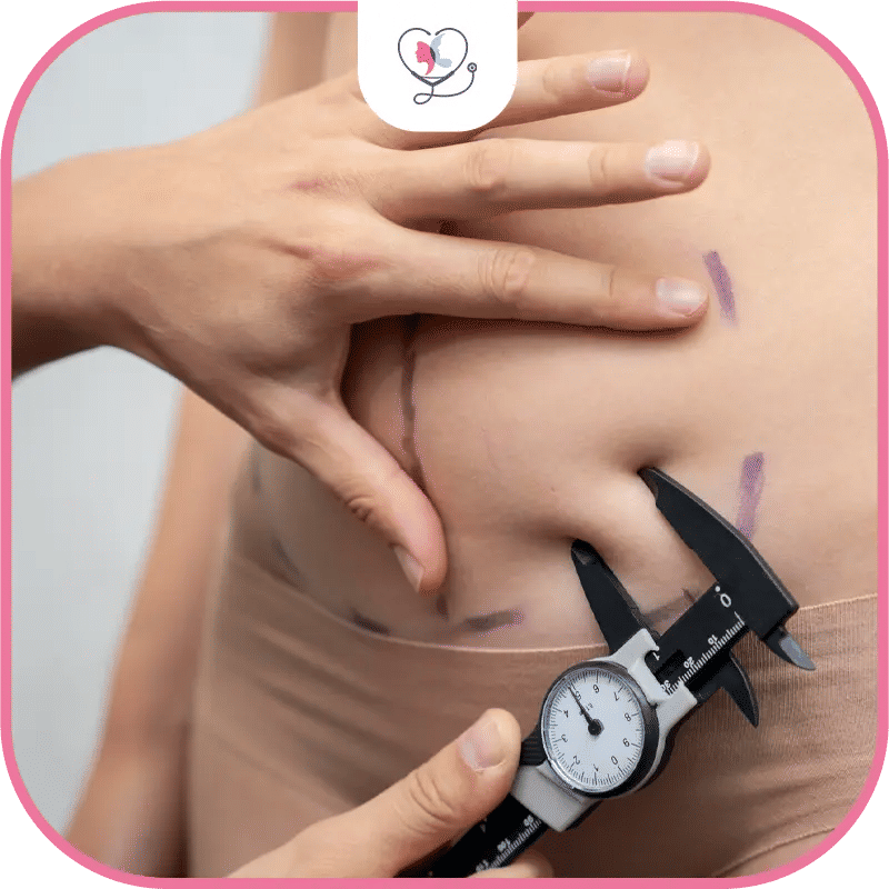 نصائح فترة المتابعة بعد عملية شفط الدهون