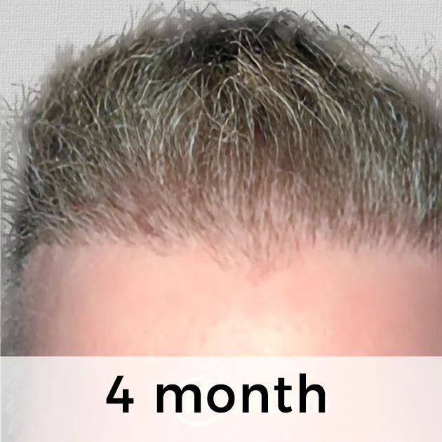3–4 Months After Hair Transplant (12 16 Weeks)