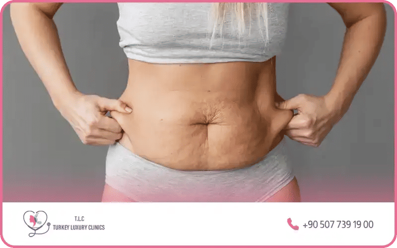 liposuccion ventre ratée