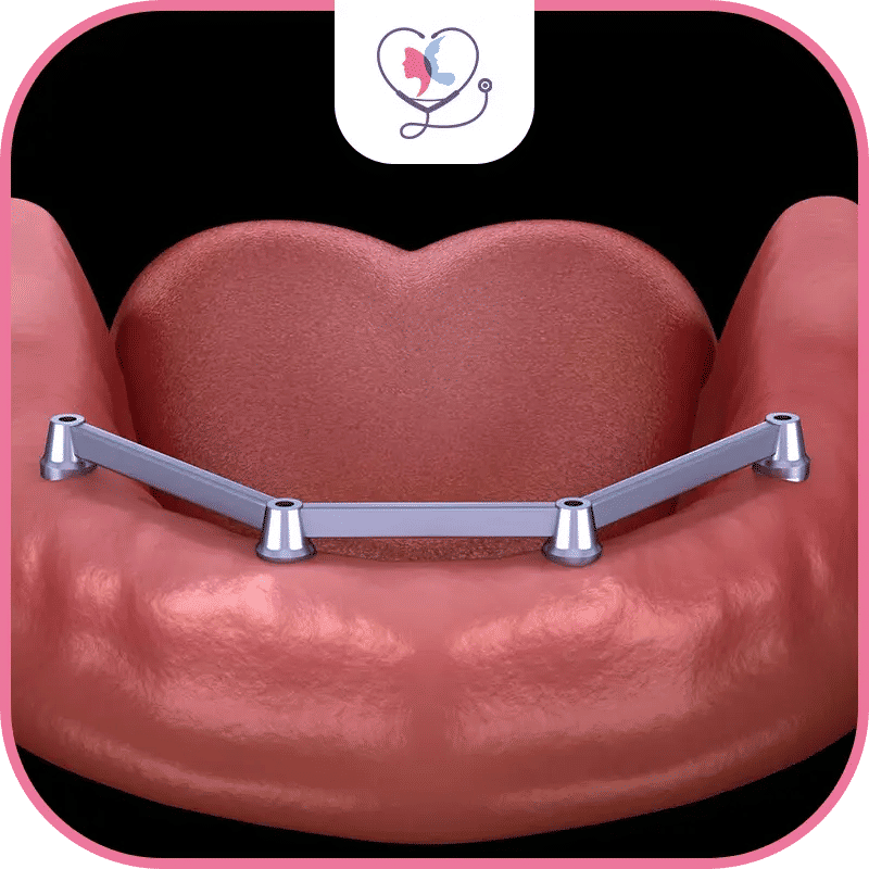 ماهي زراعة الأسنان All-on-4؟