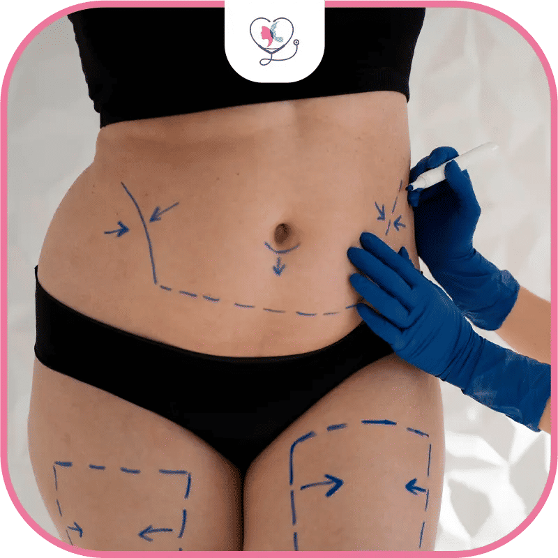 ما هي العوامل المؤثرة على نجاح شفط الدهون؟