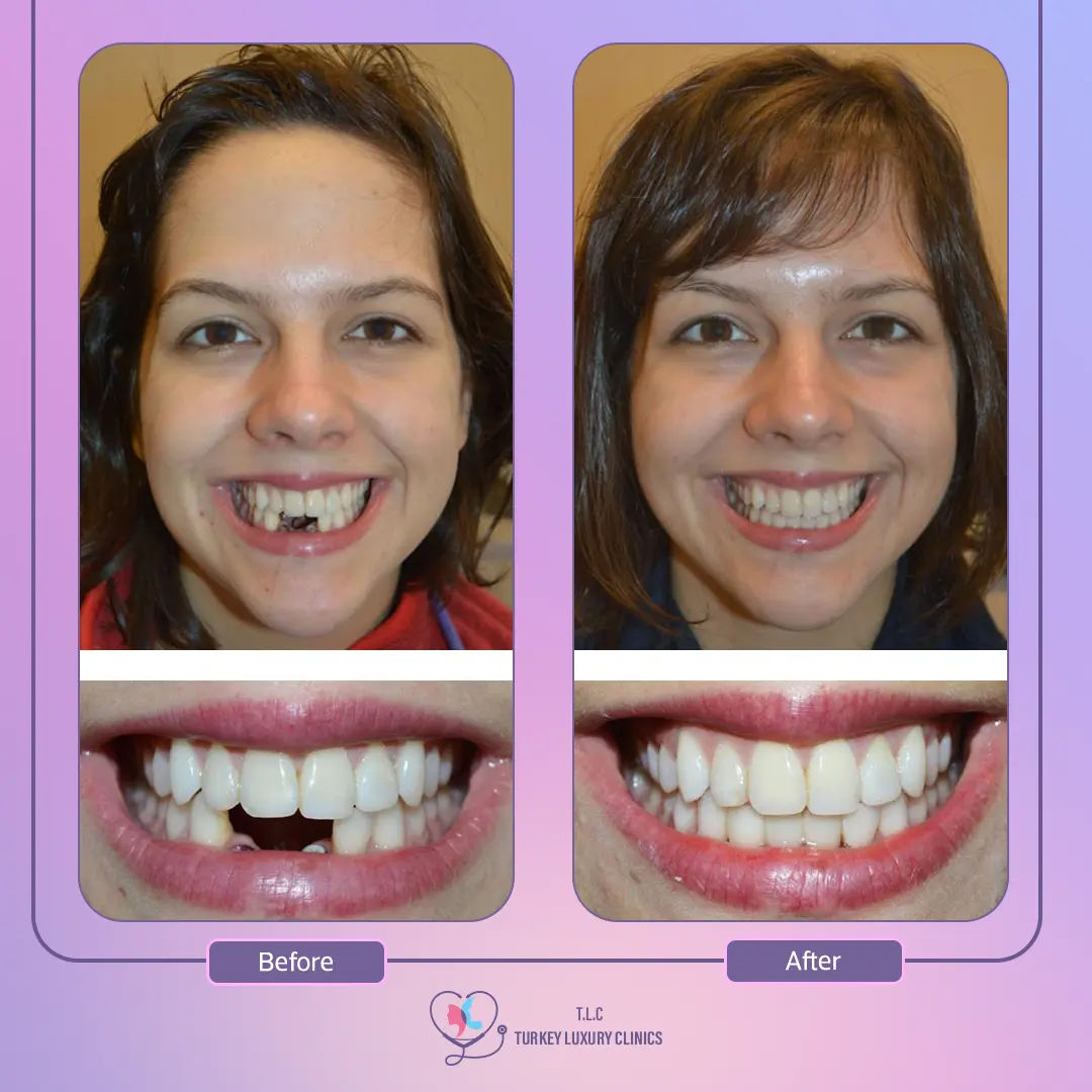 نصائح للحفاظ على تركيبة الأسنان