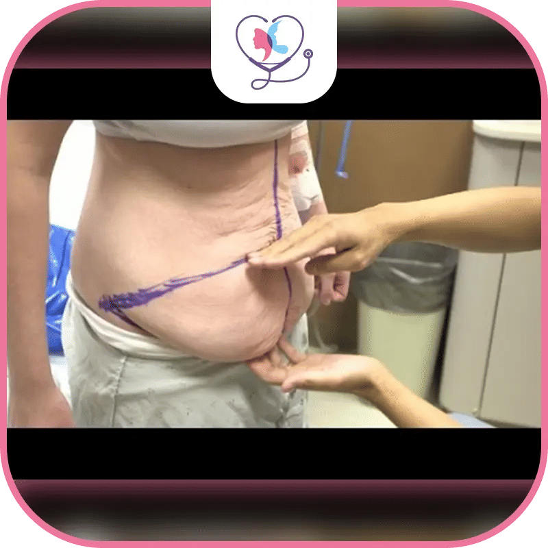 كم تستغرق عملية شد البطن؟