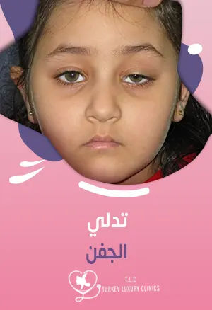 تدلي الجفن: الأسباب وخيارات العلاج الجراحية والطبيةfeatured image