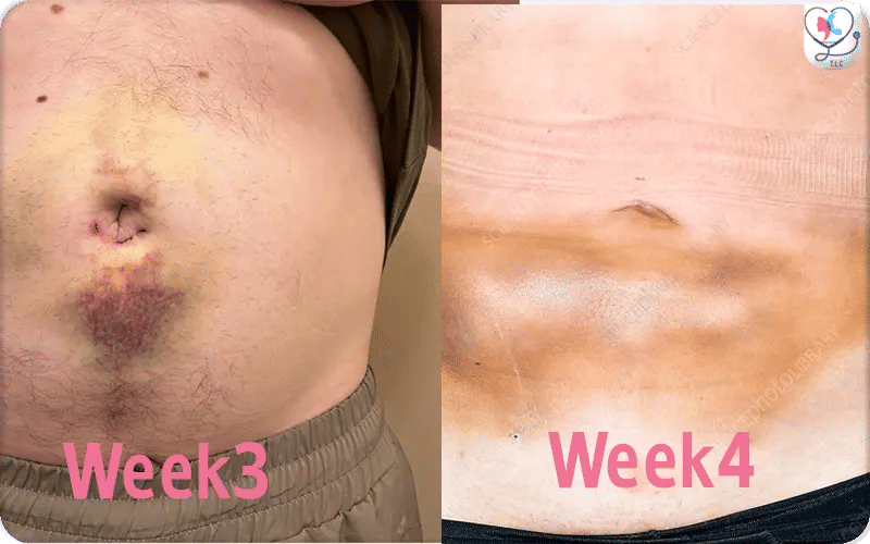 Belly Button Week 3 After Tummy Tuck