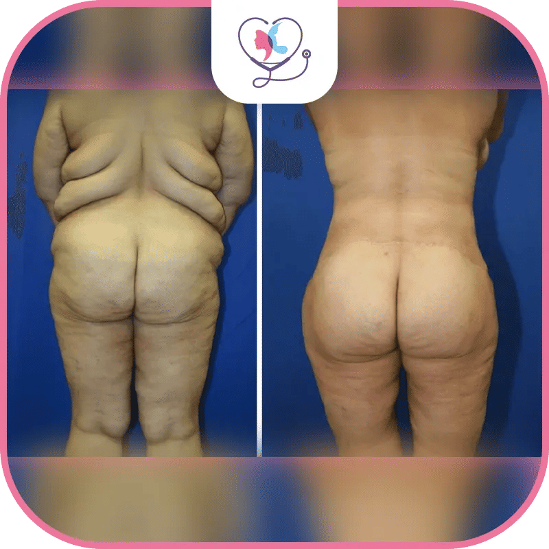 ما هي فوائد عملية شد الظهر؟