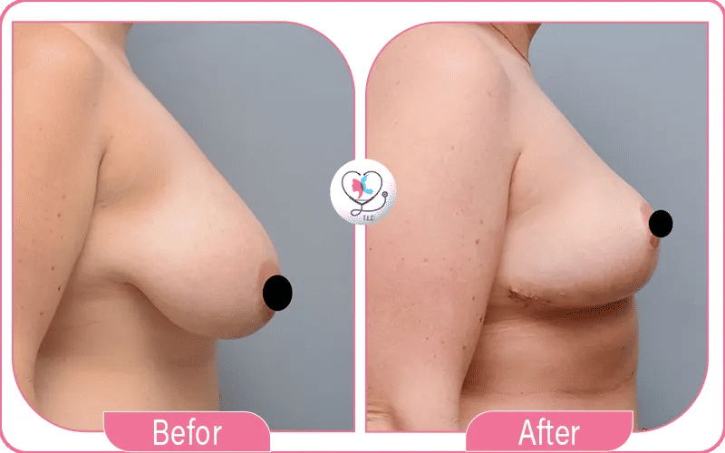 réduction mammaire avant/ après