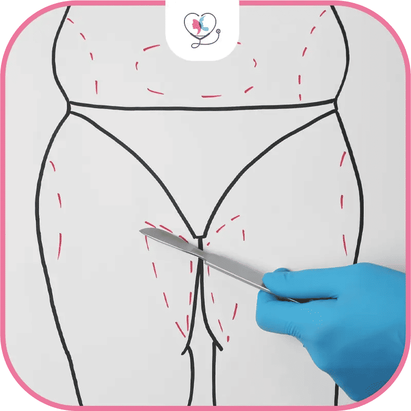 أهمية الاستعداد لشفط الدهون