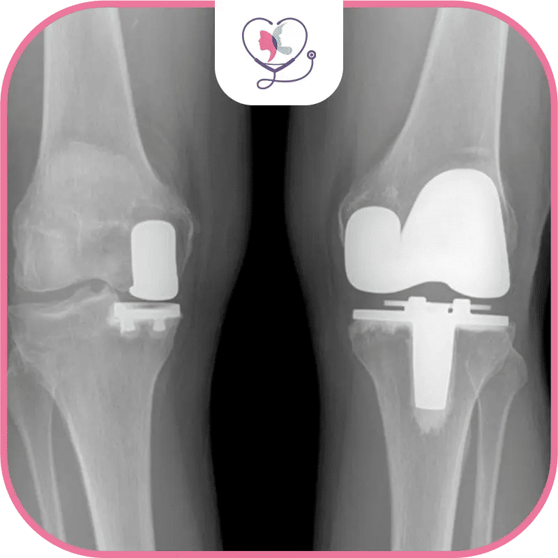 types d'arthroplastie du genou