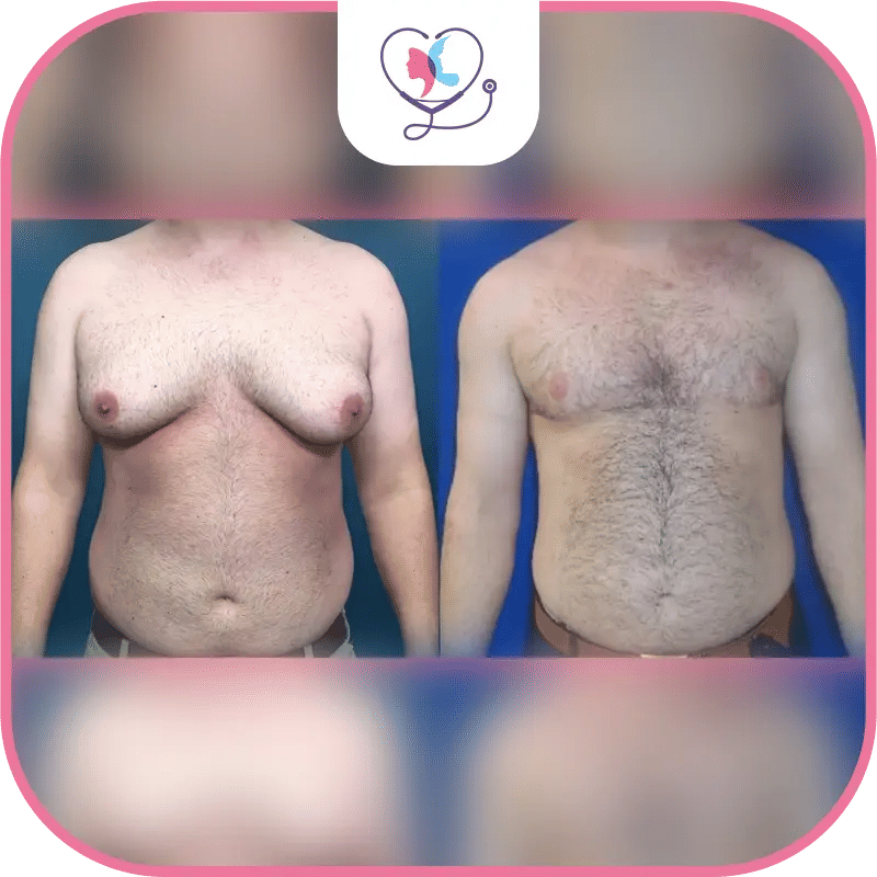 نتائج عملية التثدي