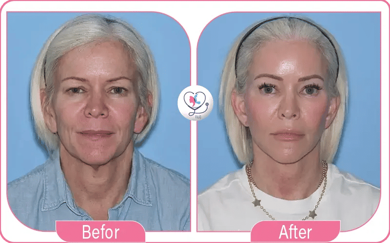 تجربتي مع رفع الحواجب في تركيا لاكشري كلينك