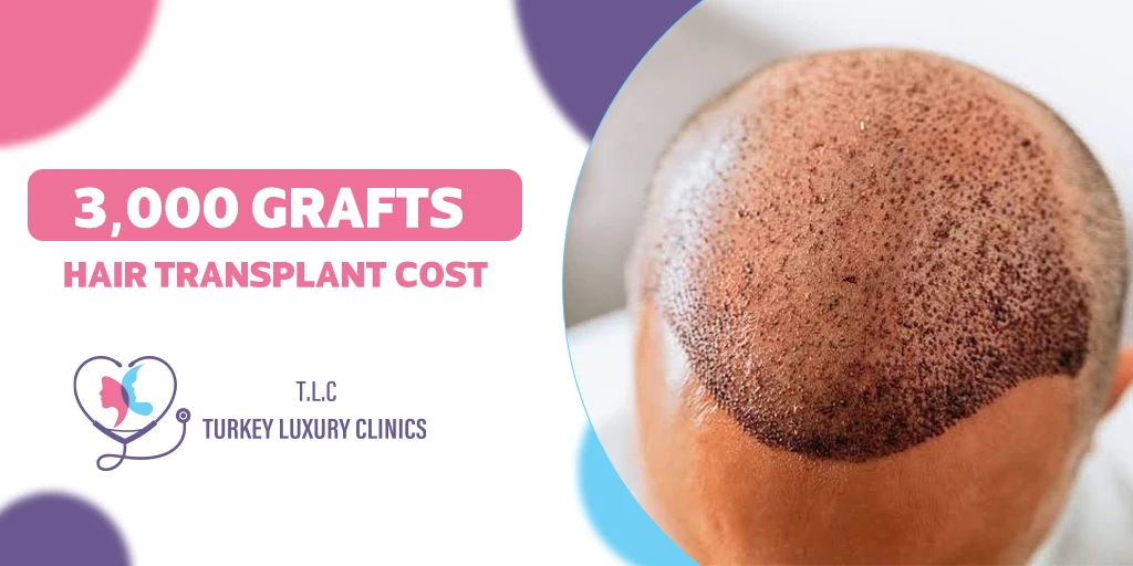 3,000 Grafts Hair Transplant Cost 2026: Complete Price Guide