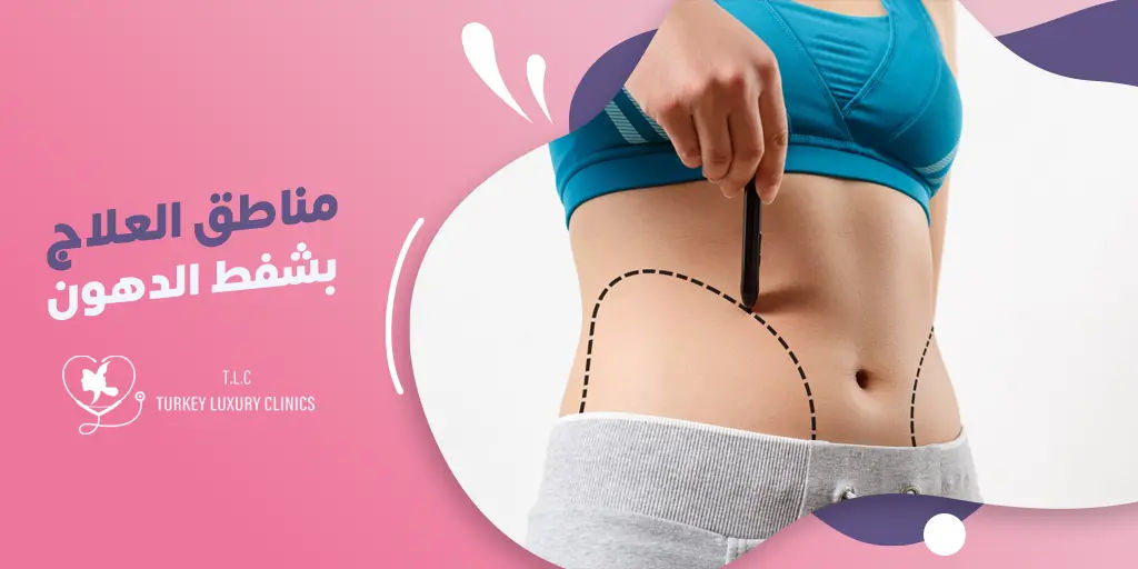 مناطق العلاج بشفط الدهون: دليلك الشامل