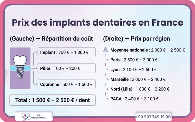 Le détail du coût implant, pilier et couronne en france
