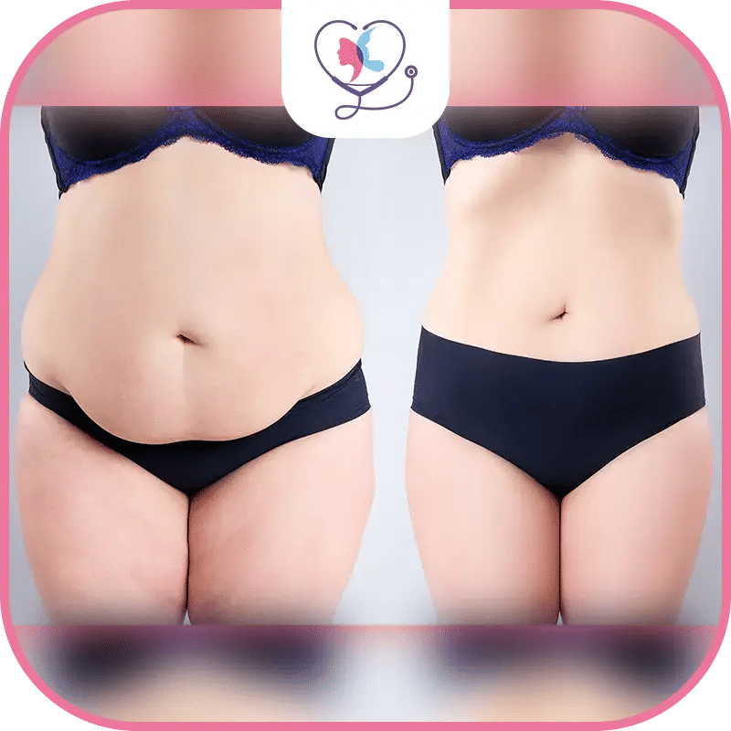 تجربتي مع عملية شد البطن