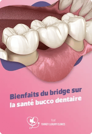 Bienfaits du bridge sur la santé bucco dentaire