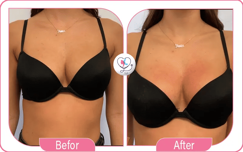 سارة: نتائج خيالية مع شد الثدي الجراحي!