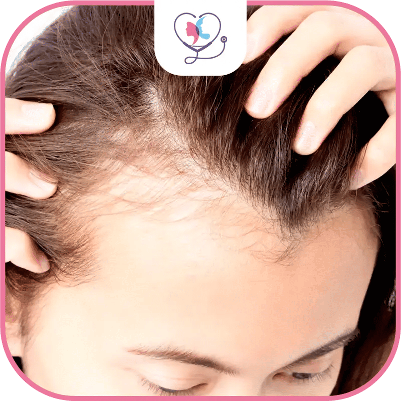 Hair Transplant for Women in Turkey