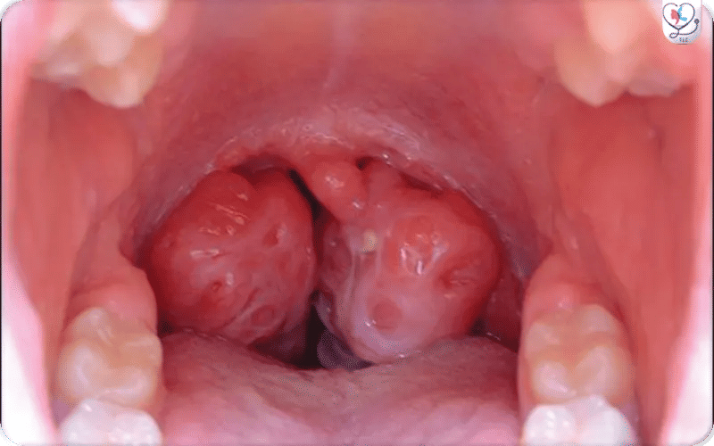 Why Eat a Soft, Cold, and Bland Diet After Tonsillectomy?