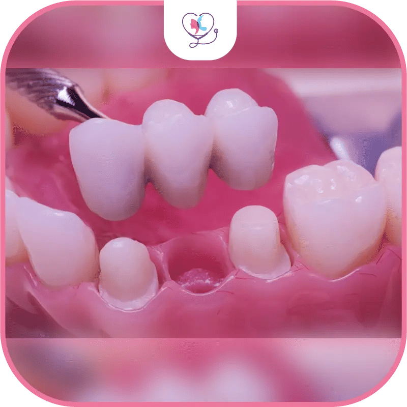 Qu'est-ce qu'un bridge dentaire en céramique ?