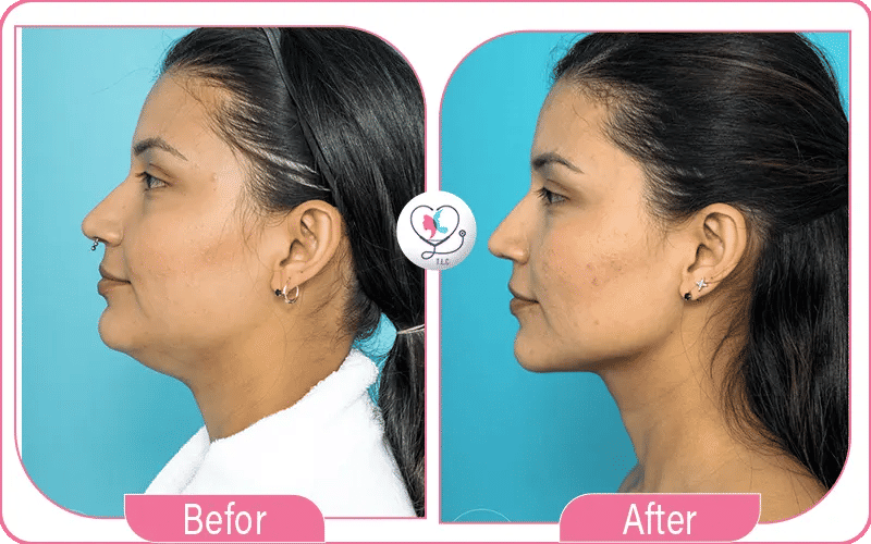 مضاعفات شد اللغلوغ بالليزر