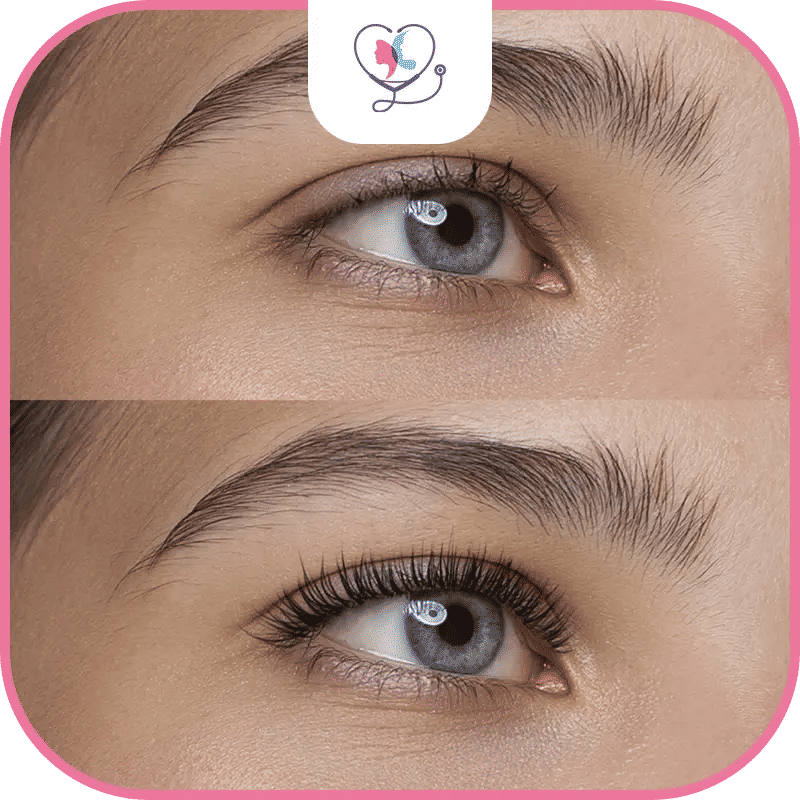 Implantation des follicules dans la zone receveuse