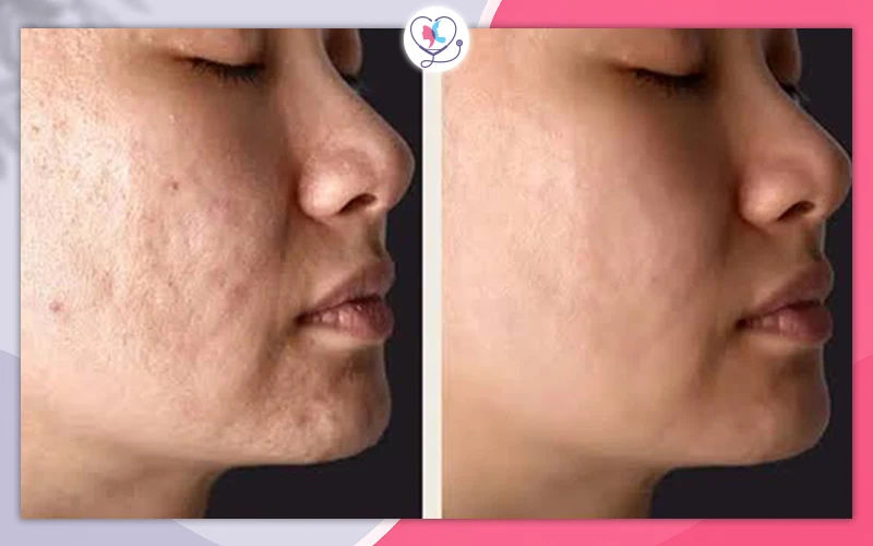 Exosome Facial Benefits: What Does It Do for Your Skin?