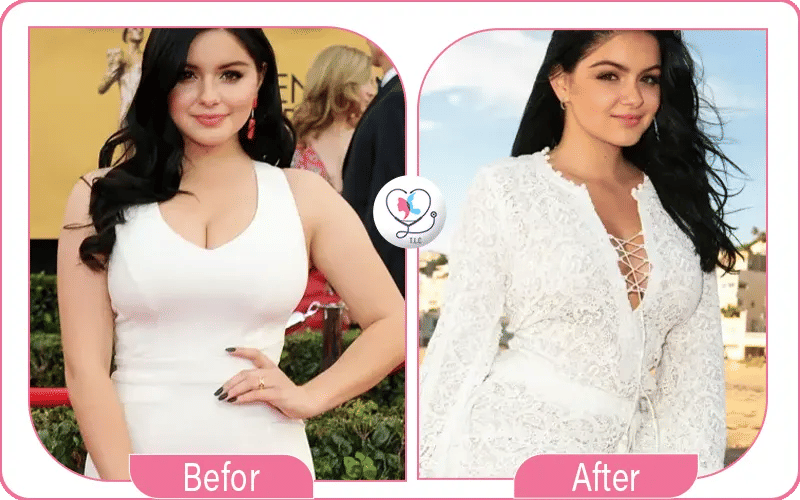 Ariel Winter Before and After Breast Reduction Surgery Photos