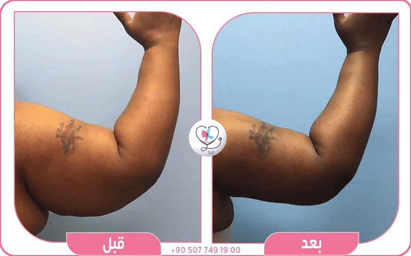 كيف تجري عملية شفط الزنود