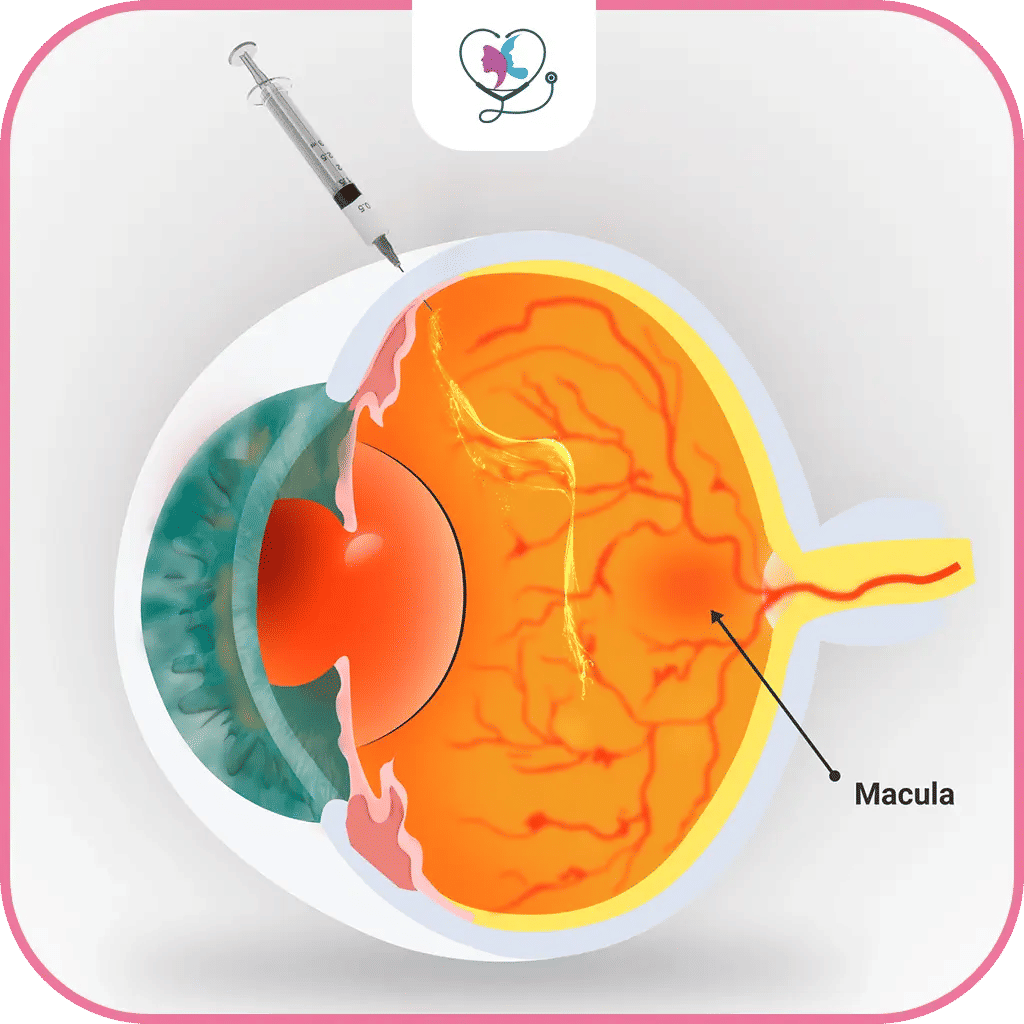 خامساً: علاج التنكس البقعي الرطب بالليزر
