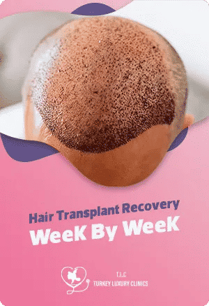 Trapianto di Capelli Settimana per Settimana: dalla Settimana 1 alla 48featured image