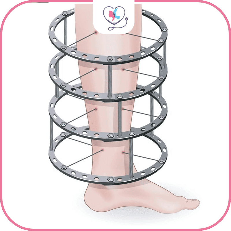 أنواع جهاز إليزاروف Ilizarov في تطويل العظام