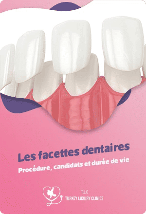 Les facettes dentaires : Procédure, candidats et durée de viefeatured image