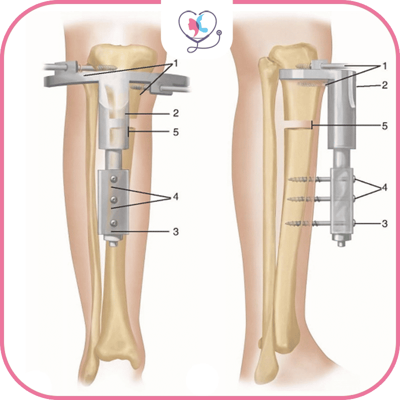 عملية تطويل الأطراف