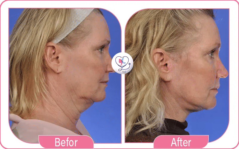 A Glance at Mini Neck Lift Before and After