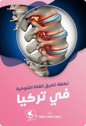 تكلفة تضيق القناة الشوكية في تركياfeatured image